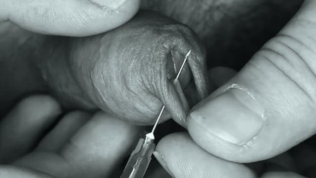 Needle in my Foreskin. Outch !